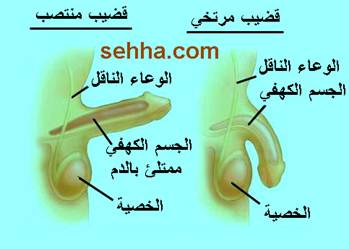 مرض السكر وتأثيره على الوظيفة الجنسية DSD1