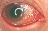 ملف كامل عن العين بالصور Conjunctivitis3