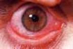 التهاب ملتحمة العين Conjunctivitis Conjunctivitis9