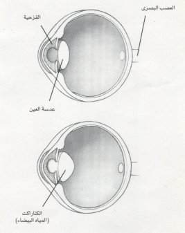 ملف كامل عن العين بالصور Cataract1