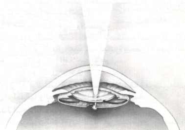 مرض الساد Cataract2