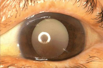 الكتاراكت ، الساد (المياه البيضاء) Cataract Cataract4