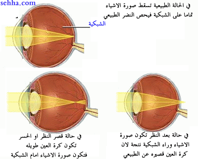 مشكلات البصر الصحية Vision problems Eye08