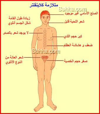 متلازمة كلاينفلتر Klinefelter_Syndrome2