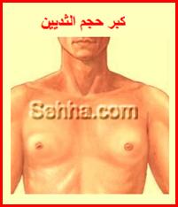 متلازمة كلاينفلتر Klinefelter_Syndrome5