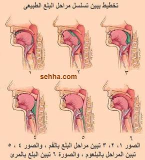  اضطراب البلع Swallowing disorder Swallowing_disorder02