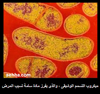 التسمم الوشيقي Botulism Botulism05