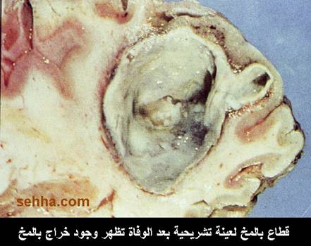  •|.♥.|• خراج المخ Brain Abscess •|. ♥.|• Brain_Abscess02