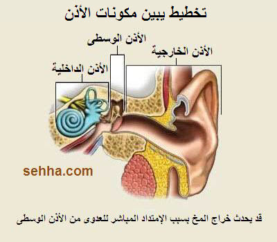  •|.♥.|• خراج المخ Brain Abscess •|. ♥.|• Brain_Abscess04