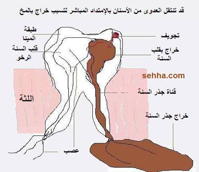  •|.♥.|• خراج المخ Brain Abscess •|. ♥.|• Brain_Abscess06