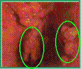 فرط التعرق Hyperhidrosis HPV2