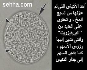 داء القطط Toxoplasmosis Toxoplasmosis05