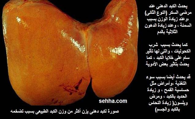 الكبد الدهني Fatty Liver Fatty-Liver