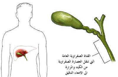 أمراض والتهابات المرارة Gall bladder diseases Gallbladder9