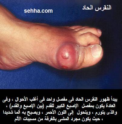 موضوعنا اليوم عن النقرس اسبابه واعراضه وعلاجه Gout04