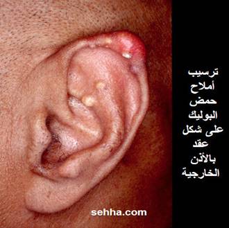 موضوعنا اليوم عن النقرس اسبابه واعراضه وعلاجه Gout05