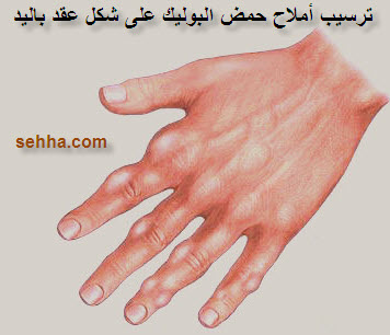 موضوعنا اليوم عن النقرس اسبابه واعراضه وعلاجه Gout07