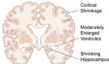 مرض الزهايمر Alzheimer04