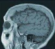 صحة وطب...موسوعة طبية Alzheimer10