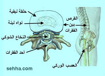 عرق النسا sciatica Sciatica3