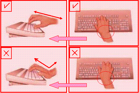 متلازمة النفق الرسغي What is the Carpal Tunnel CTS22