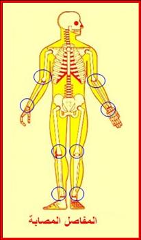 التهاب المفاصل التفاعلي - متلازمة ريتر  Reactive Arthritis - Reiter Syndrome Reiter01