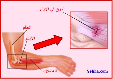 مرفق لاعب التنس Tennis Elbow TennisElbow3