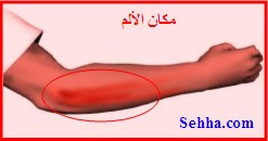 مرفق لاعب التنس Tennis Elbow TennisElbow4