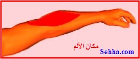 مرفق لاعب التنس Tennis Elbow TennisElbow5