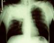 الالتهاب الرئوي Pneumonia B-pn