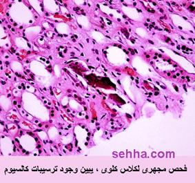 اعرف الكلس الكلوي  وطريقة علاجه Nephrocalcinosis01