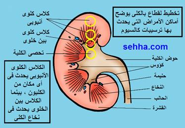 اعرف الكلس الكلوي  وطريقة علاجه Nephrocalcinosis03