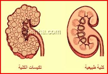 مرض التكيس الكلوي Polycystic kidney disease - PKD PKD01