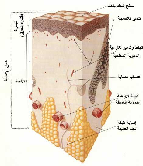 ( موضوع شامل و كامل عن الحروق Burns )( Burn3d