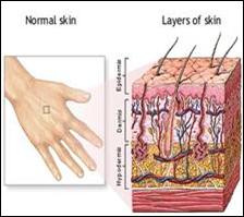 الاسعافات الاولية للحروق Burns-FA08