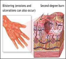 الإسعافات الأولية للحروق First aid for burns Burns-FA10