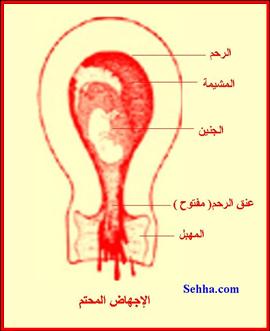 الإجهاض - الإجهاض التلقائي Inevitable