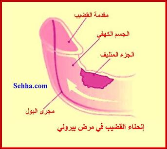 مرض بيروني ( انحناء القضيب ) Peyronie's Disease - Penile Curvature Peyronie2