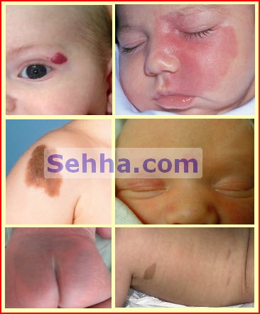  وحمات الولاده (birthmarks) ##ممنوع دخول الحوامل!!! Birthmarks01