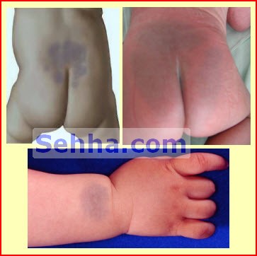  وحمات الولاده (birthmarks) ##ممنوع دخول الحوامل!!! Birthmarks04