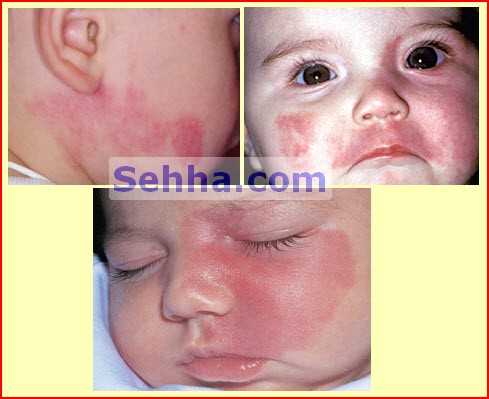  وحمات الولاده (birthmarks) ##ممنوع دخول الحوامل!!! Birthmarks05