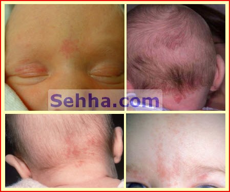 وحمات الولادة - 6  Birthmarks06