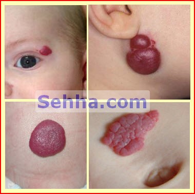  وحمات الولاده (birthmarks) ##ممنوع دخول الحوامل!!! Birthmarks07