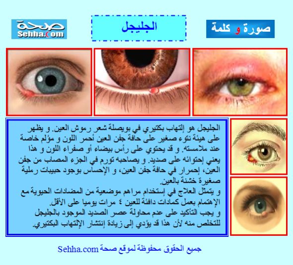 الجليجل(التهاب بكتيري) Stye