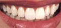 ملف كامل عن طب الاسنان بالصور A_bleach