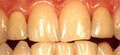 ملف كامل عن طب الاسنان  A_veneers