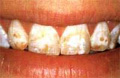 ملف كامل عن طب الأسنان بالصور B_bonding