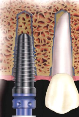 ملف كامل عن طب الاسنان بالصور Implant02