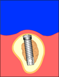 ملف كامل عن طب الاسنان بالصور Implant4