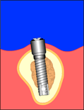 ملف كامل عن الأسنان Implant8